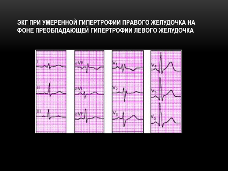 Изменения миокарда левого желудочка сердца. ЭКГ при гипертрофии желудочков. ЭКГ при гипертрофии миокарда левого желудочка. Критерии гипертрофии левого желудочка на ЭКГ. ЭКГ критерии гипертрофии желудочков.