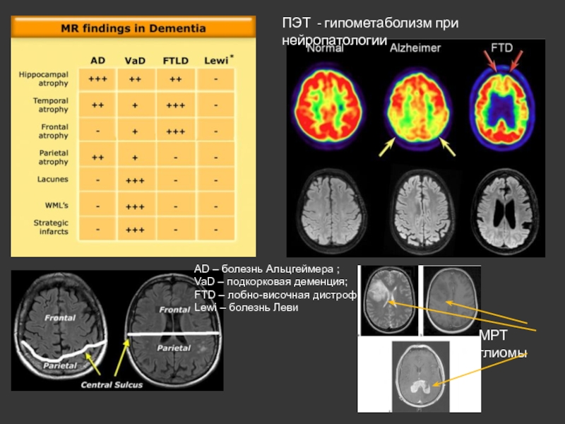 Лобно височная деменция. Лобно-височная деменция мрт. Мрт при лобно-височная деменция. Альцгеймера, лобно-височная деменция. Лобно-височная деменция у подростков.