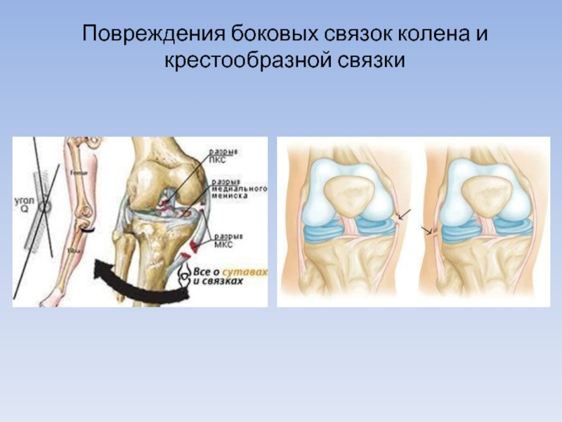 Латеральная коллатеральная связка коленного. Повреждение внутренней боковой связки. Боковые крестообразные связки колена.