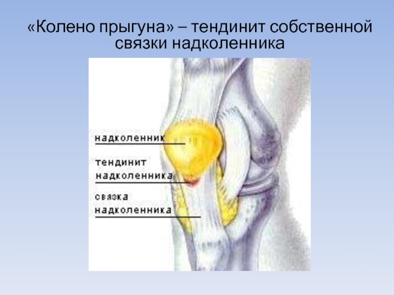 Собственная связка. Оссификация связки надколенника. Тендинит собственной связки надколенника. Тендиноз собственной связи надколенника. Собственная связка надколенника.