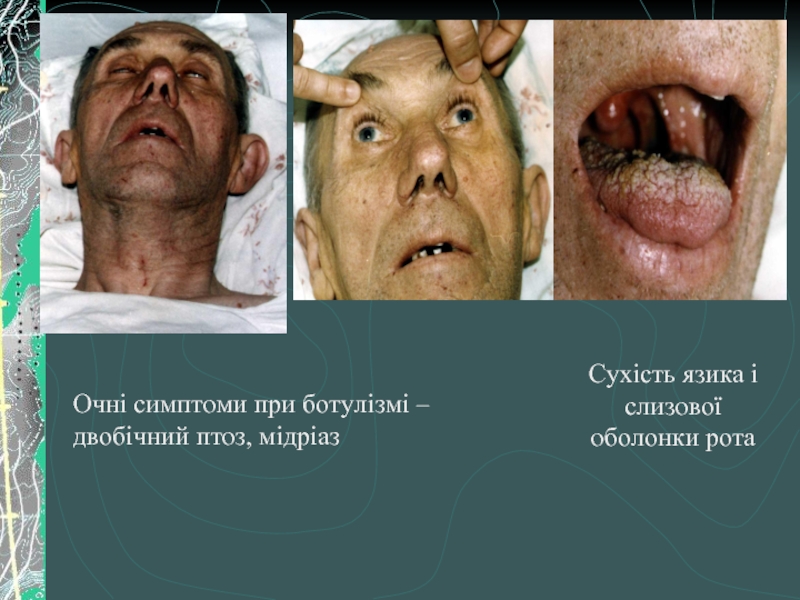 Очні симптоми при ботулізмі – двобічний птоз, мідріаз Сухість язика і