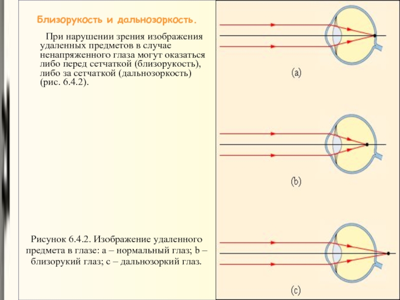 Что располагается в глазу человека перед сетчаткой. Нарушение зрения близорукость дальнозоркость. Глаз нормальный близорукий дальнозоркий. Изображение предмета для близорукого глаза. Изображение предмета при близорукости.