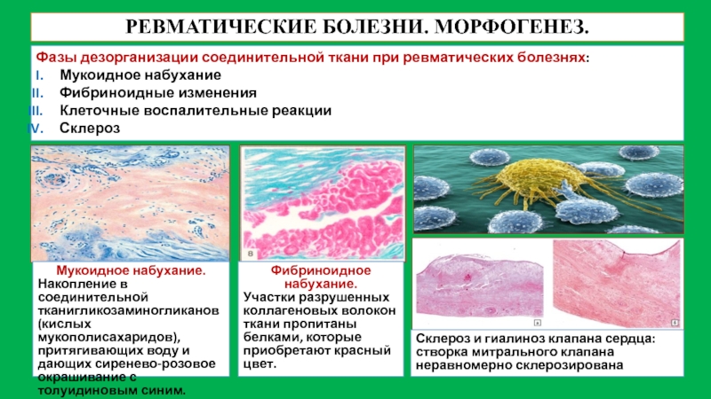 Морфологические изменения болезни. Морфогенез ревматизма патанатомия. Этапы дезорганизации соединительной ткани при ревматизме. Изменение соединительной ткани при ревматизме. Стадиями дезорганизации соединительной ткани.