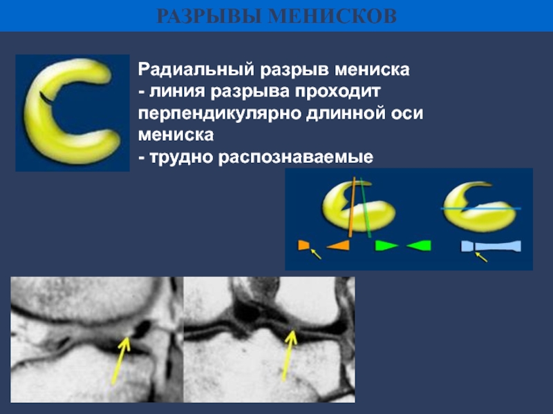 Разрыв мениска карта вызова