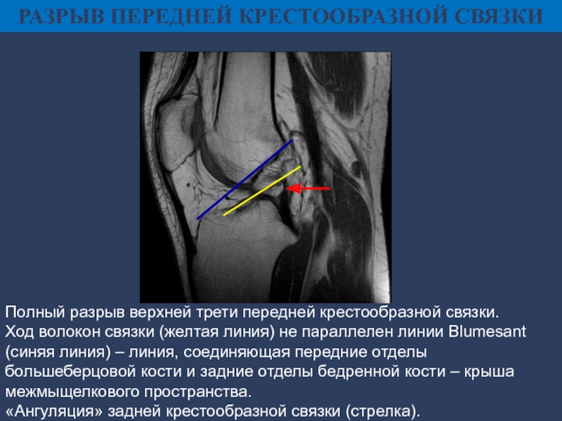 Повреждение передней крестообразной связки коленного сустава фото