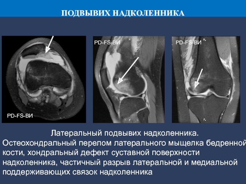 Подвывих надколенника. Хондральное повреждение надколенника. Хондральный перелом надколенника. Привычный вывих надколенника кт. Подвывих коленного сустава мрт.