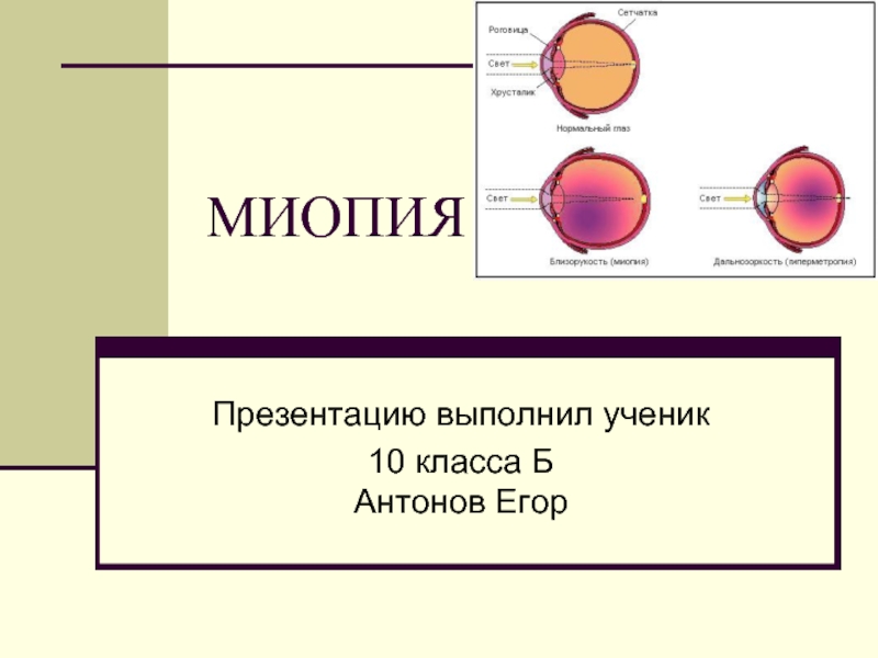 Презентация по теме миопия