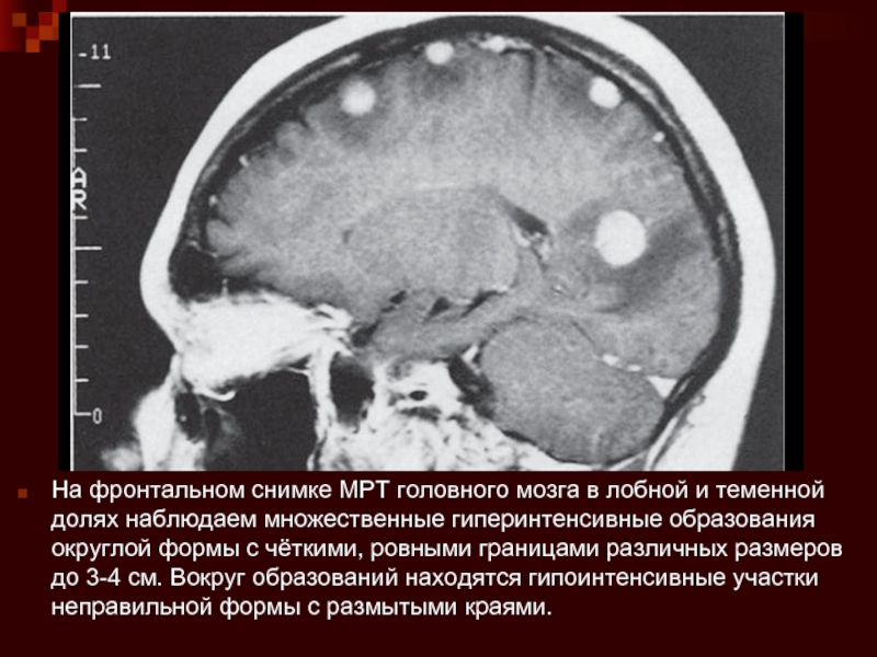 Образование в мозге. Теменная доля кт. Округлые образования головного мозга. Теменная доля мрт.