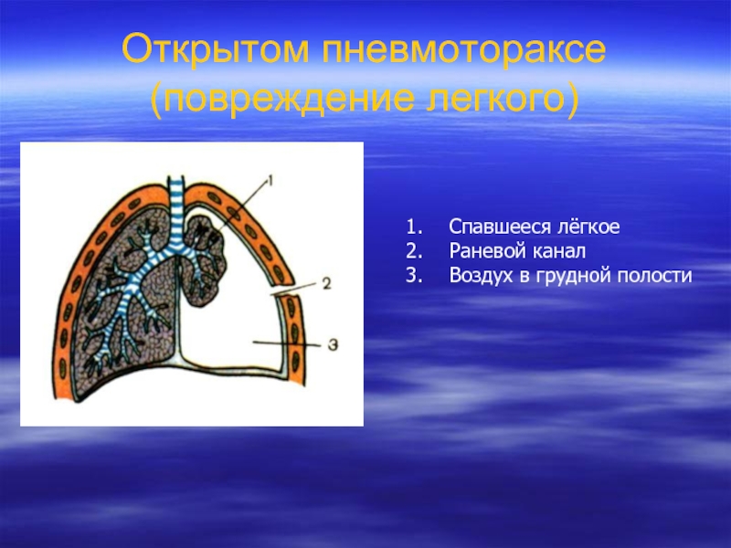 Повреждение легких. Спонтанный пневмоторакс. Пневмоторакс спадение легкого. Открытые повреждения легких. Пневмоторакс спавшееся легкое.