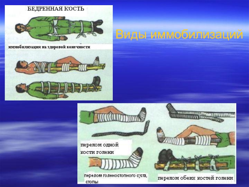 Иммобилизация при переломе костей конечностей