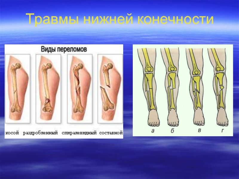 Травмы верхних и нижних конечностей презентация