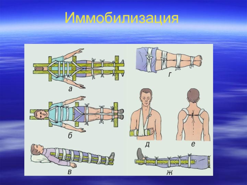 Иммобилизация это. Иммобилизация. Временной иммобилизации. Современная иммобилизация. Иммобилизация поврежденной области.