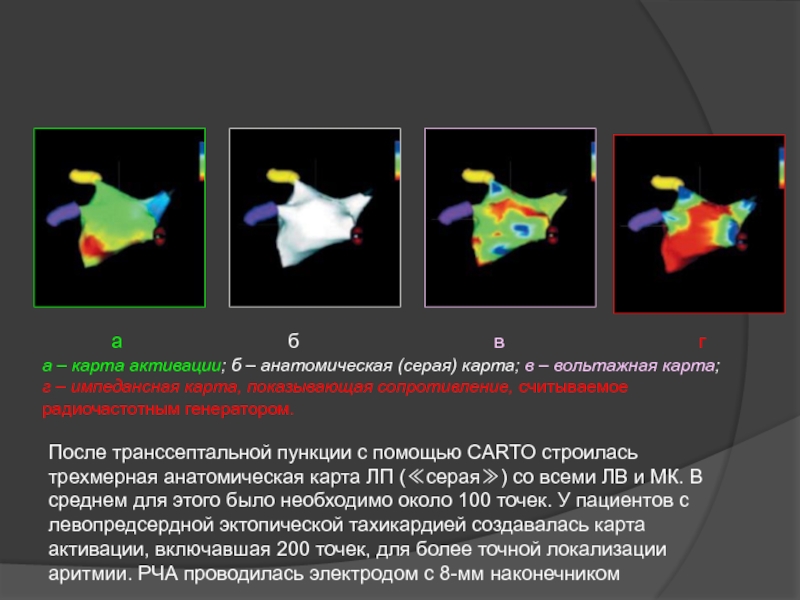 После транссептальной пункции с помощью CARTO строилась трехмерная анатомическая карта ЛП