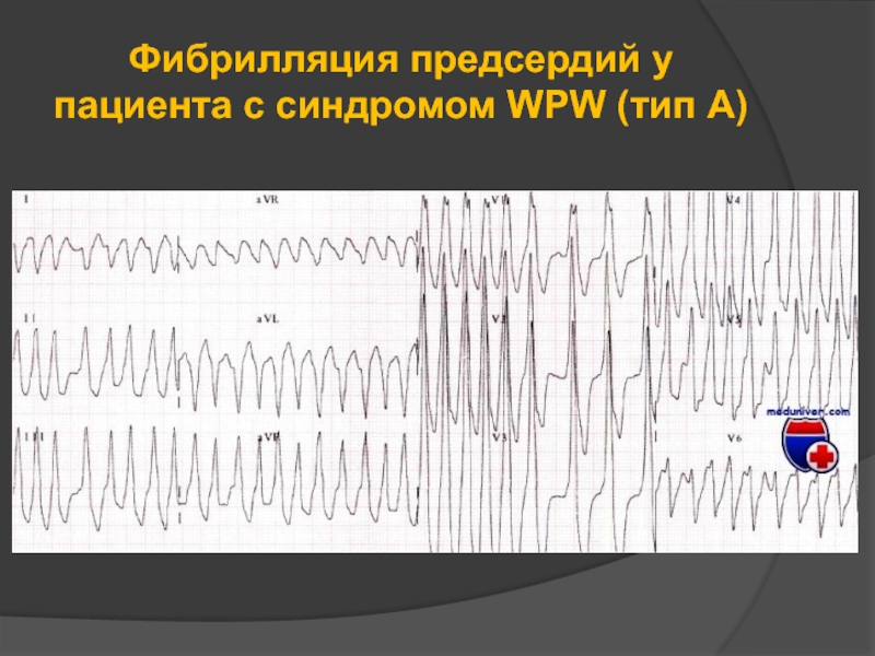 Фибрилляция предсердий у пациента с синдромом WPW (тип А)