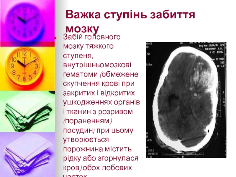 Важка ступінь забиття мозкуЗабій головного мозку тяжкого ступеня, внутрішньомозкові гематоми (обмежене