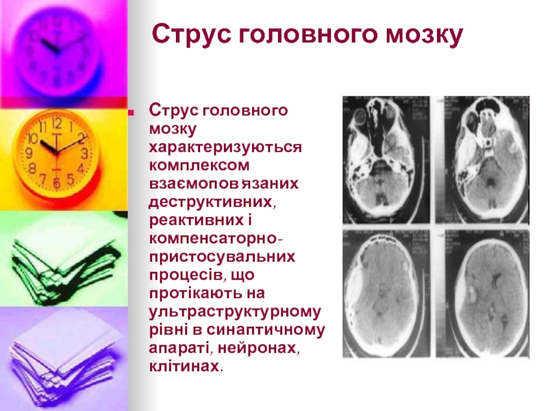 Струс головного мозкуСтрус головного мозку характеризуються комплексом взаємопов'язаних деструктивних, реактивних і