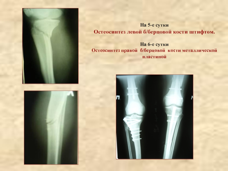 Б левой. Юношеский остеохондроз большой и малой берцовых костей. Штифт большой берцовой кости. Остеосинтез берцовой кости штифтом.
