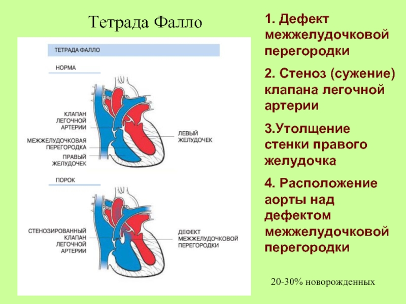 1. Дефект межжелудочковой перегородки2. Стеноз (сужение) клапана легочной артерии 3.Утолщение стенки