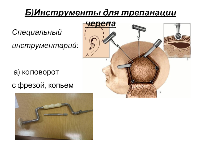 Б)Инструменты для трепанации черепаСпециальный инструментарий: а) коловорот с фрезой, копьем