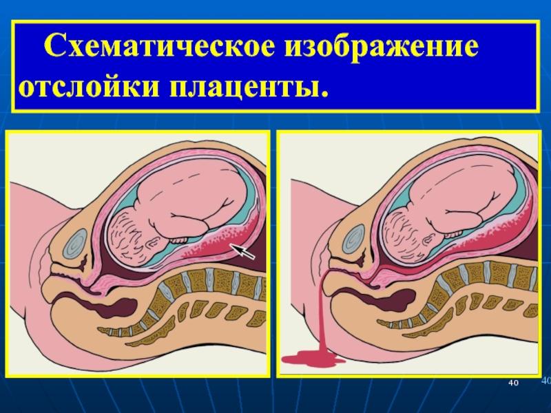 Схематическое изображение отслойки плаценты.