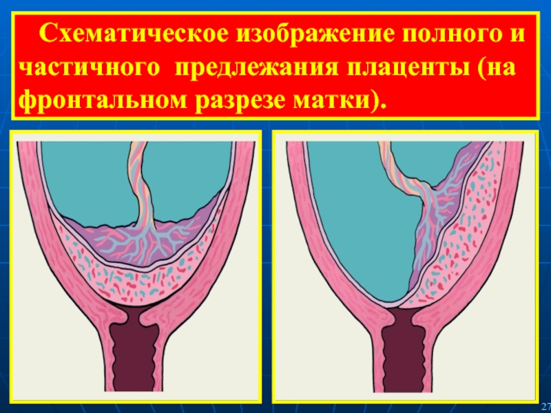 Схематическое изображение полного и частичного предлежания плаценты (на фронтальном разрезе матки).