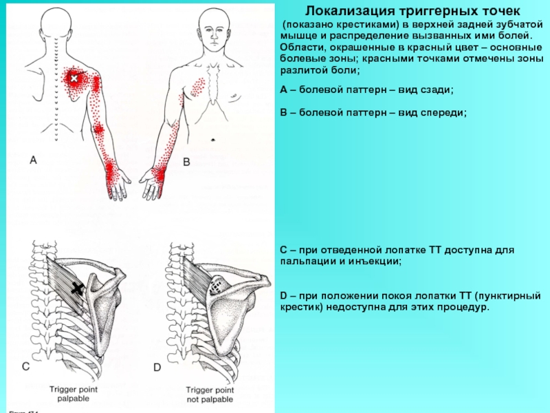 Задняя зубчатая мышца триггерные точки. Триггерные точки в лопаточной области. Триггерные точки в задней-верхней зубчатой мышце. Триггерные точки зубчатой мышцы.