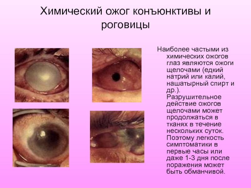 Химический ожог конъюнктивы и роговицыНаиболее частыми из химических ожогов глаз являются