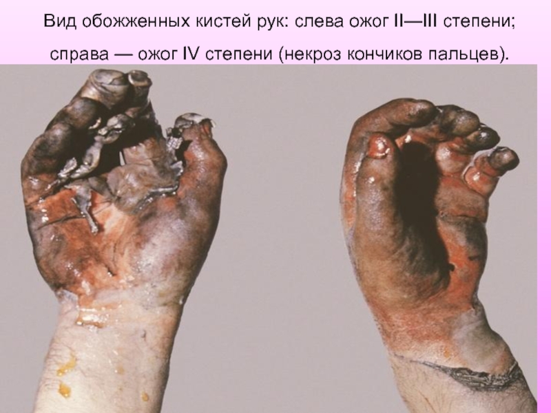 Вид обожженных кистей рук: слева ожог II—III степени; справа — ожог