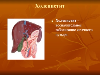 Воспалительное заболевание желчного пузыря холецистит