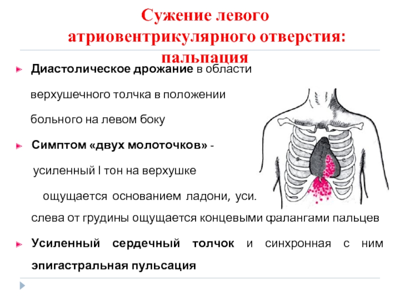 Верхушечный толчок. Синдром стеноза левого атриовентрикулярного отверстия. Сужение левого атриовентрикулярного отверстия. Признаки стеноза левого атриовентрикулярного отверстия. Стеноз левого атриовентрикулярного отверстия пальпация.