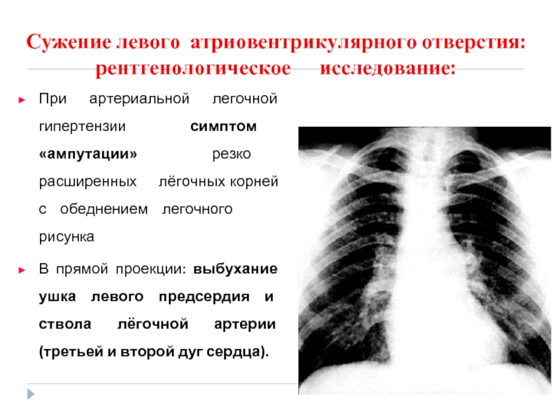 Ампутация корней легких при рентгенологической картине характерна для