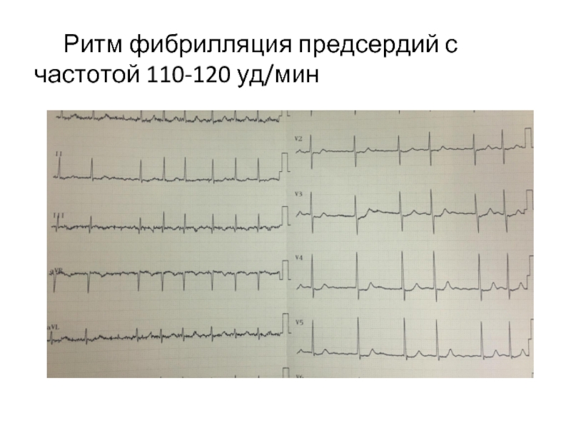 Фибрилляция предсердий с частотой 110-96. Фибрилляция предсердий с частотой 150-100. Фибрилляция предсердий 130 уд. Фибрилляция предсердий для протезирования.