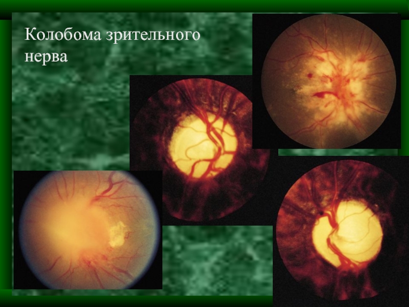 Аномалия развития зрительного нерва. Миелиновые волокна зрительного нерва. Колобома диска зрительного нерва на УЗИ.