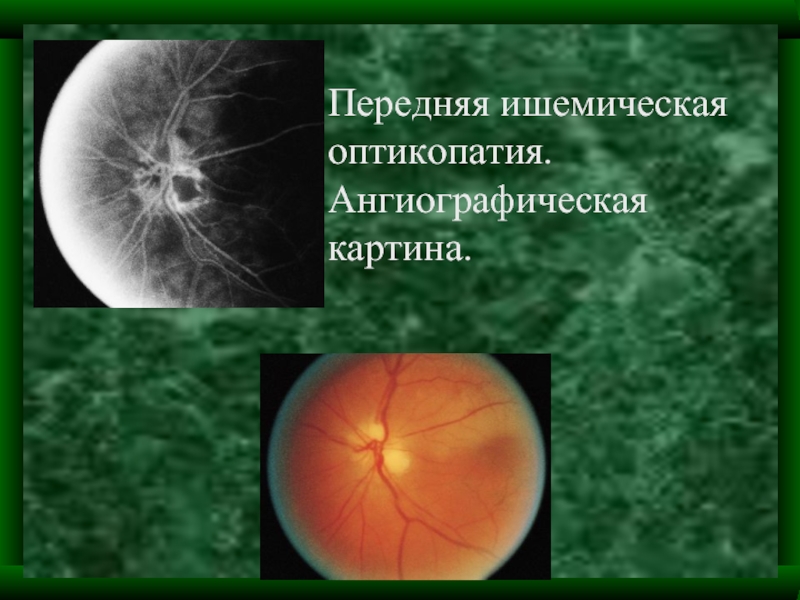 Передняя ишемическая нейропатия зрительного. Задняя ишемическая оптиконейропатия. Передняя ишемическая оптикопатия. Оптикопатия зрительного нерва. Ишемическая оптикопатия зрительного нерва.