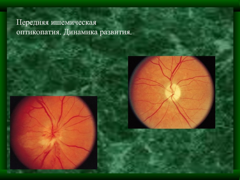 Нейропатия глаза. Нейрооптикопатия зрительного нерва. Ишемическая нейропатия зрительного нерва мкб. Ишемическая оптикопатия зрительного нерва. Ишемическая нейрооптикопатия зрительного нерва.