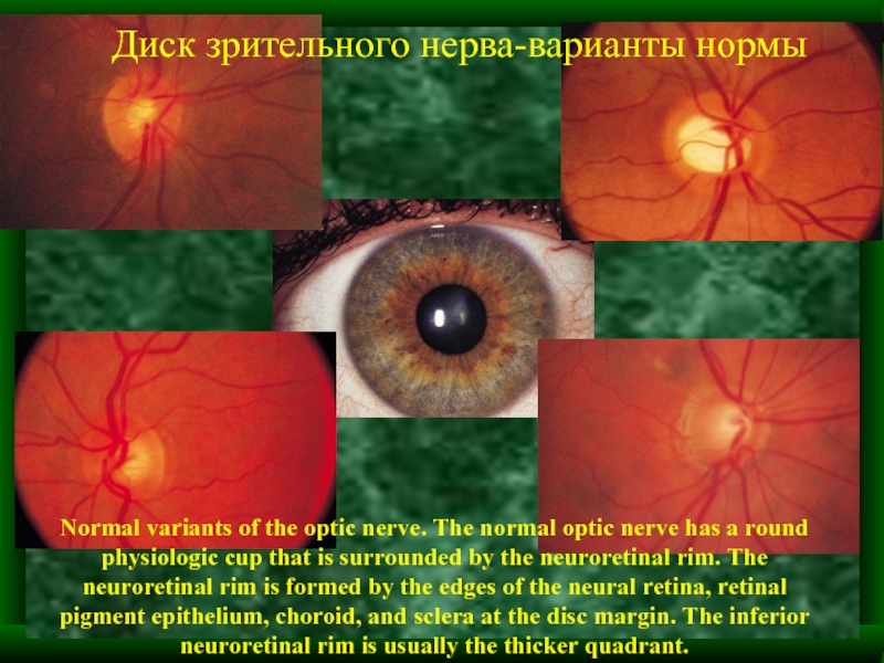 Норма зрительного нерва. Экскавация диска зрительного нерва окт. Опухоли зрительного нерва глазное дно.