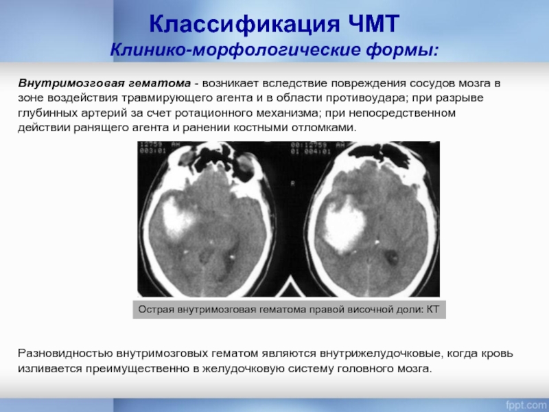 Классификация ЧМТ Клинико-морфологические формы:Внутримозговая гематома - возникает вследствие повреждения сосудов мозга в