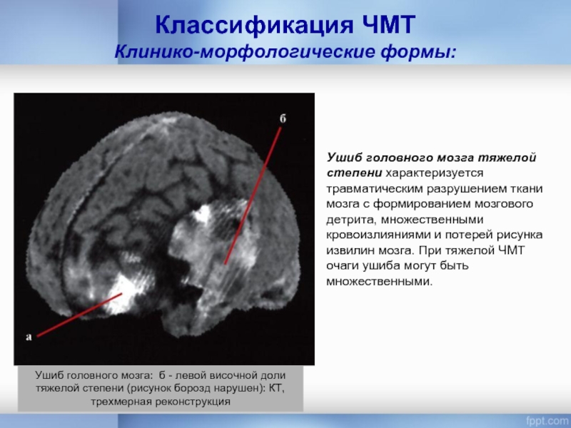 Классификация ЧМТ Клинико-морфологические формы:Ушиб головного мозга тяжелой степени характеризуется травматическим разрушением ткани
