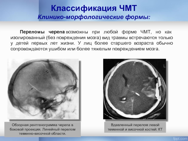Классификация ЧМТ Клинико-морфологические формы:Переломы черепа возможны при любой форме ЧМТ, но как