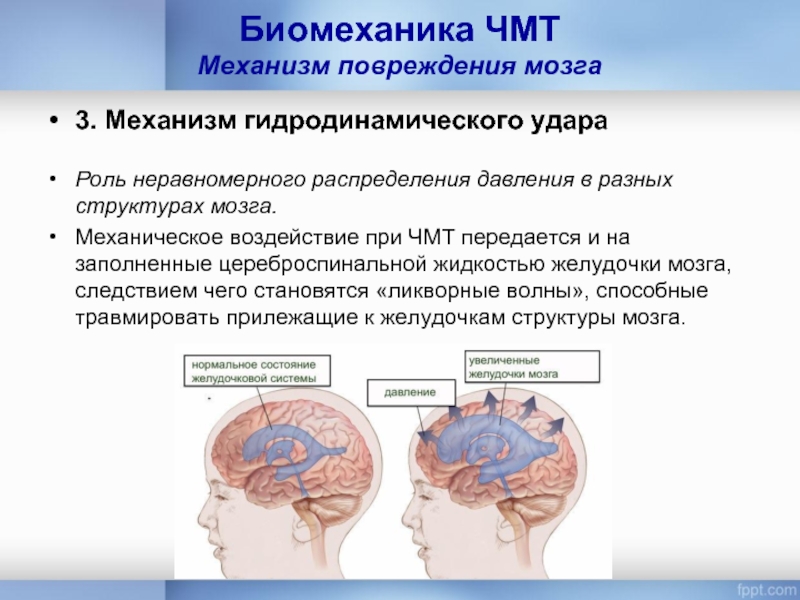 Биомеханика ЧМТ Механизм повреждения мозга3. Механизм гидродинамического удараРоль неравномерного распределения давления