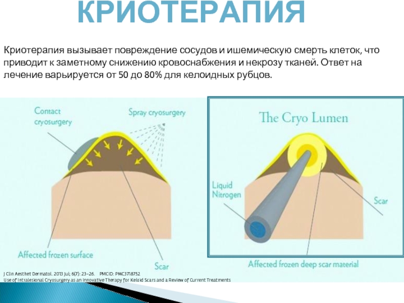 Келоидный рубец пластырь