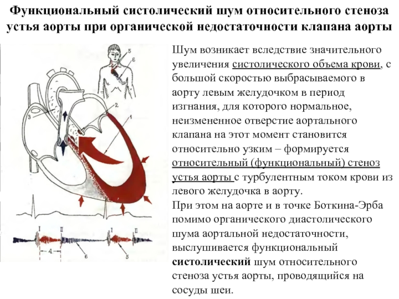 Аускультативная картина при аортальном стенозе характеризуется появлением