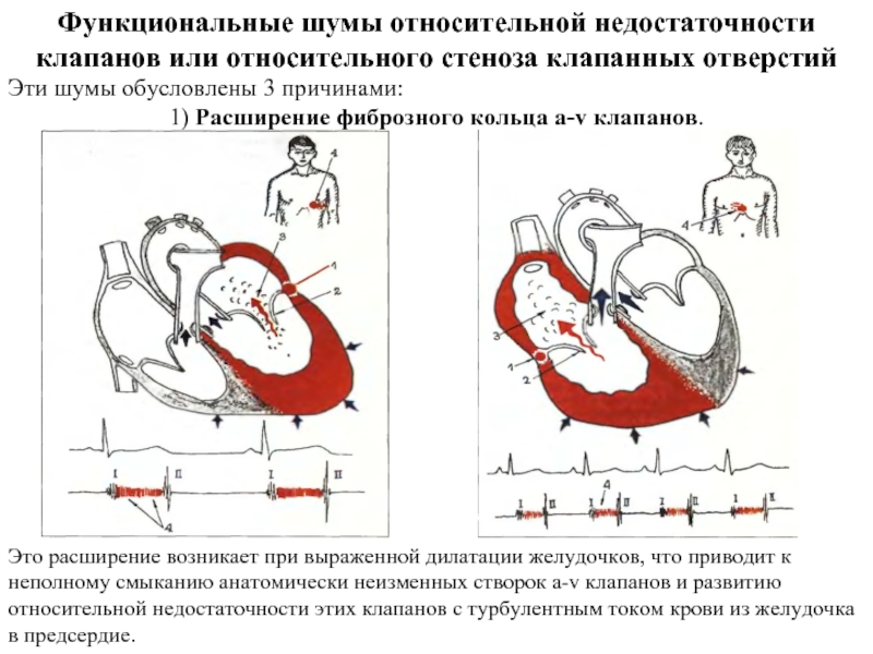 Недостаточность митрального клапана картинка