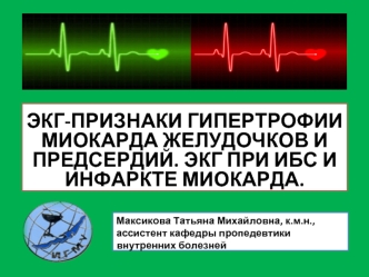 ЭКГ-признаки гипертрофии миокарда желудочков и предсердий. ЭКГ при ИБС и инфаркте миокарда