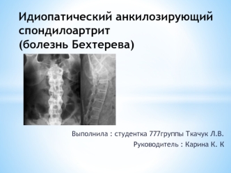 Идиопатический анкилозирующий спондилоартрит (болезнь Бехтерева)