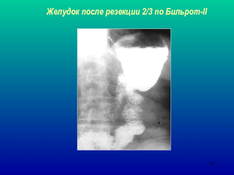 Желудок после. Резекция желудка по Бильрот 2 рентген. После резекции желудка. Резекция 2/3 желудка по Бильрот. Лучевая диагностика желудка.