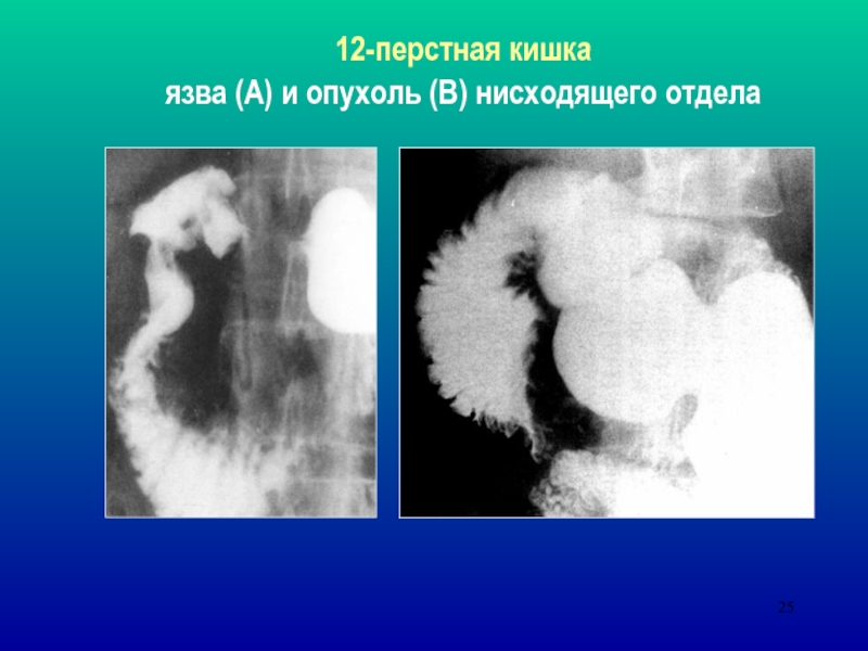 Рентгенологическое исследование желудка фото