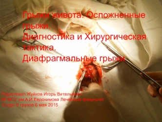 Грыжи живота. Осложненные грыжи. Диагностика и хирургическая тактика