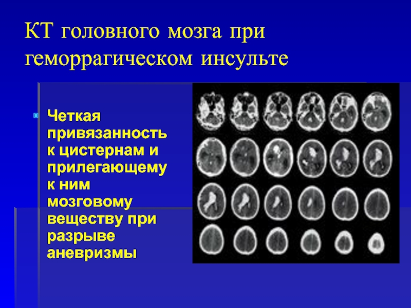 КТ головного мозга при геморрагическом инсультеЧеткая привязанность к цистернам и прилегающему