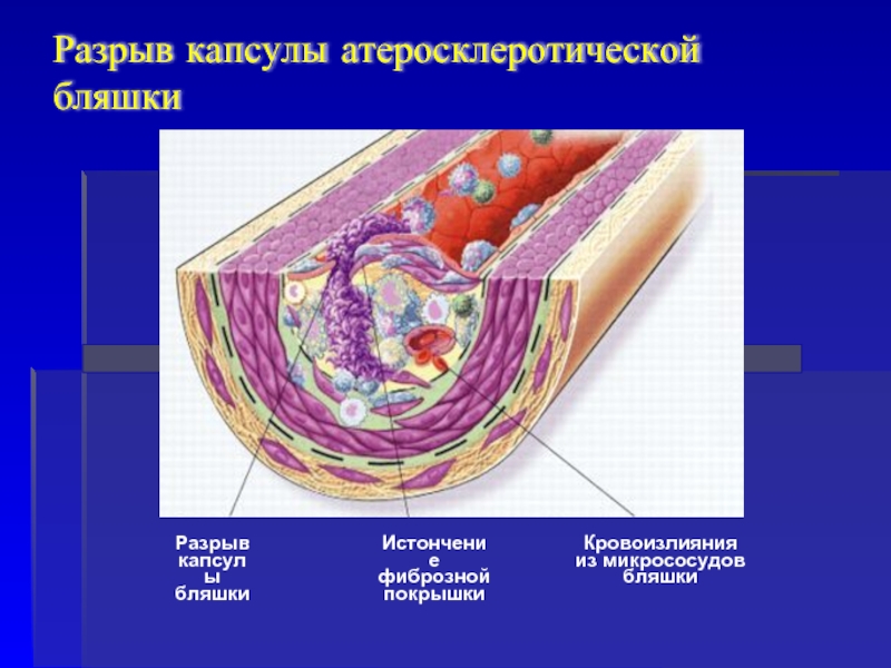 ИстончениефибрознойпокрышкиКровоизлиянияиз микрососудовбляшкиРазрывкапсулыбляшкиРазрыв капсулы атеросклеротической бляшки